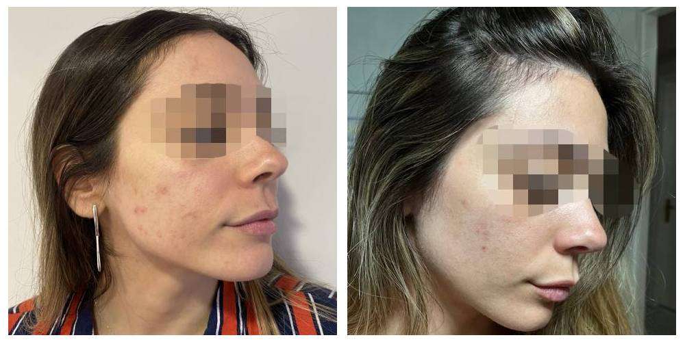 SkinDuo treatment before + after_12
