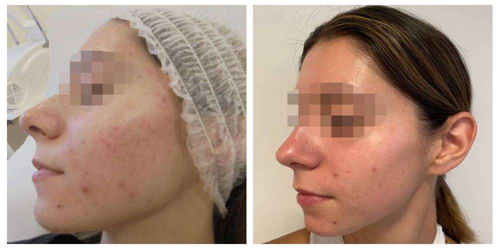 SkinDuo treatment before + after_14