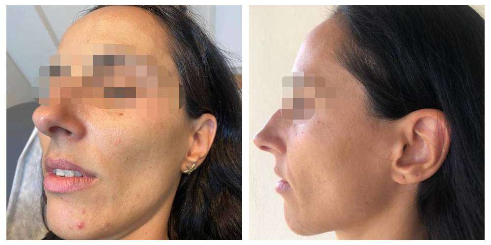 SkinDuo treatment before + after_2