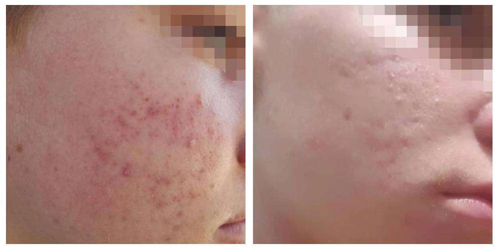 SkinDuo treatment before + after_3