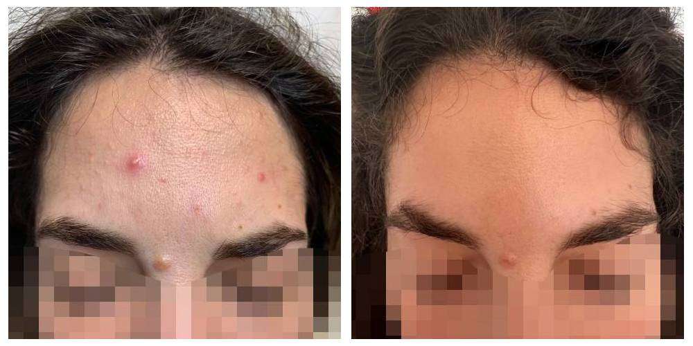 SkinDuo treatment before + after_7