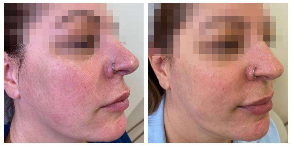 SkinDuo treatment before + after_8