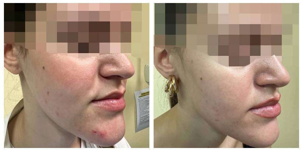 SkinDuo treatment before + after_9_v2